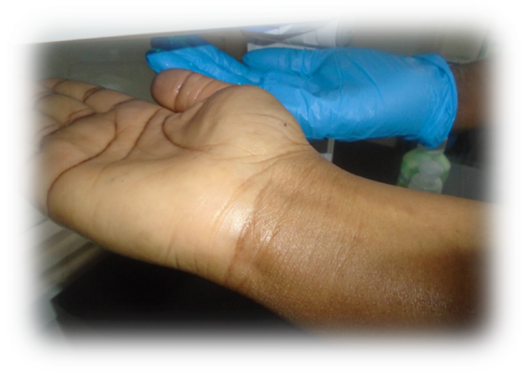 Image of a hand without gloves and with gloves